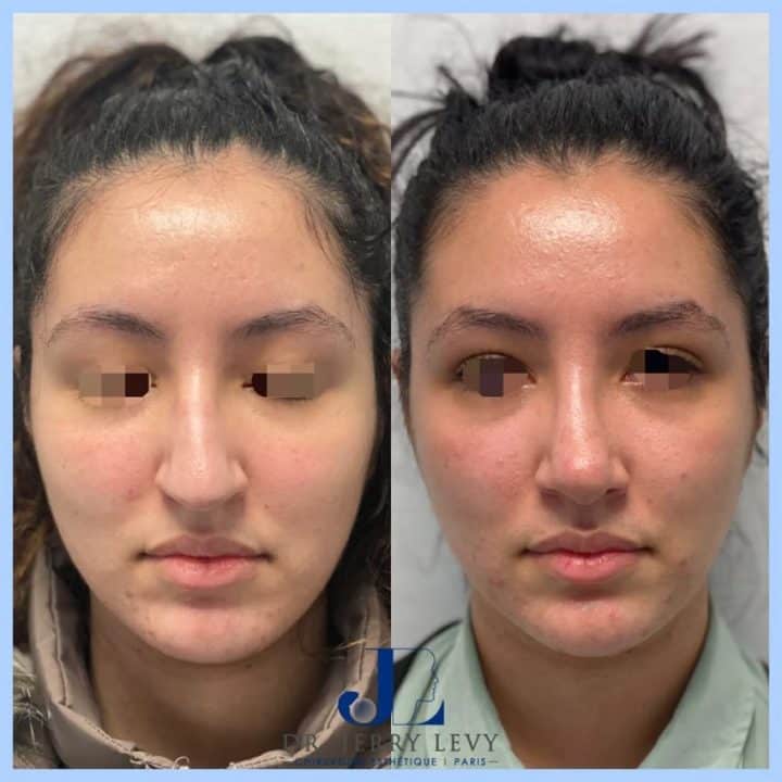 Les meilleures rhinoplasties sont-elles forcément à Paris?