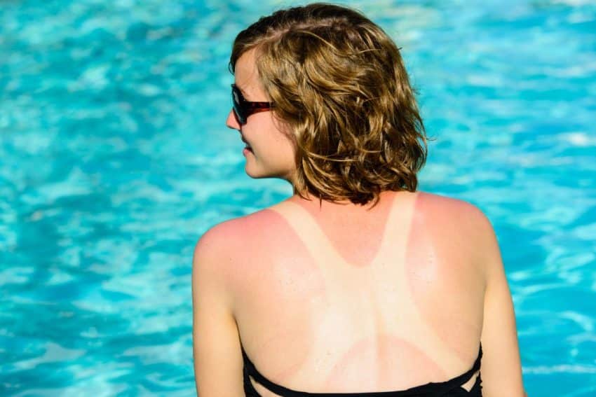Les trois meilleures façons de soigner un coup de soleil